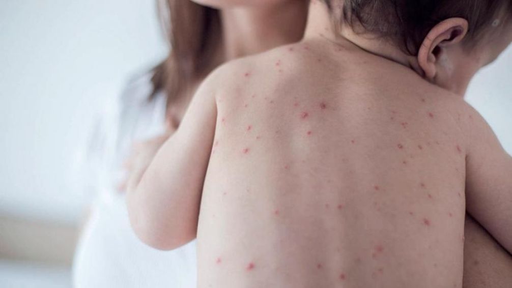 Salud recordó la importancia de la prevención contra el sarampión